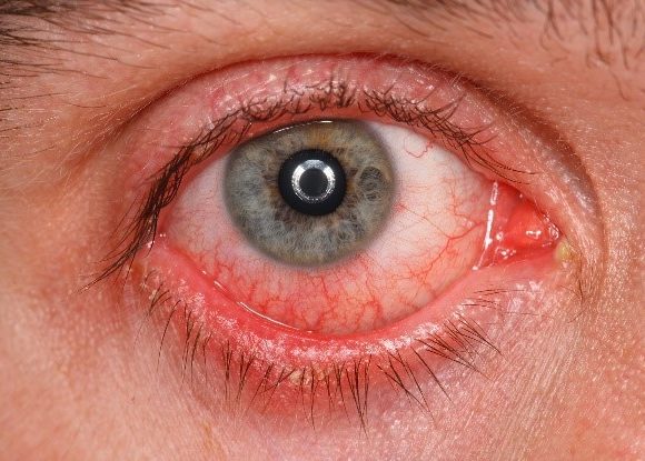 Corneal & External Eye Disease